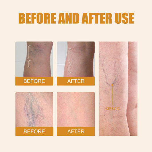 Varicose Veins Leg Care Pen, Skin Soothing Treatment for Leg Comfort & Appearance Support